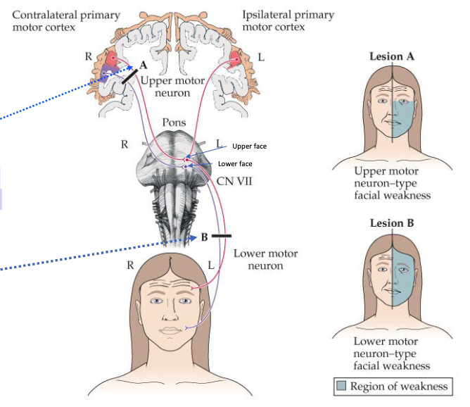 <p>In an UMN lesion (A), the upper face is spared because both hemispheres contribute to movement of the upper face</p>