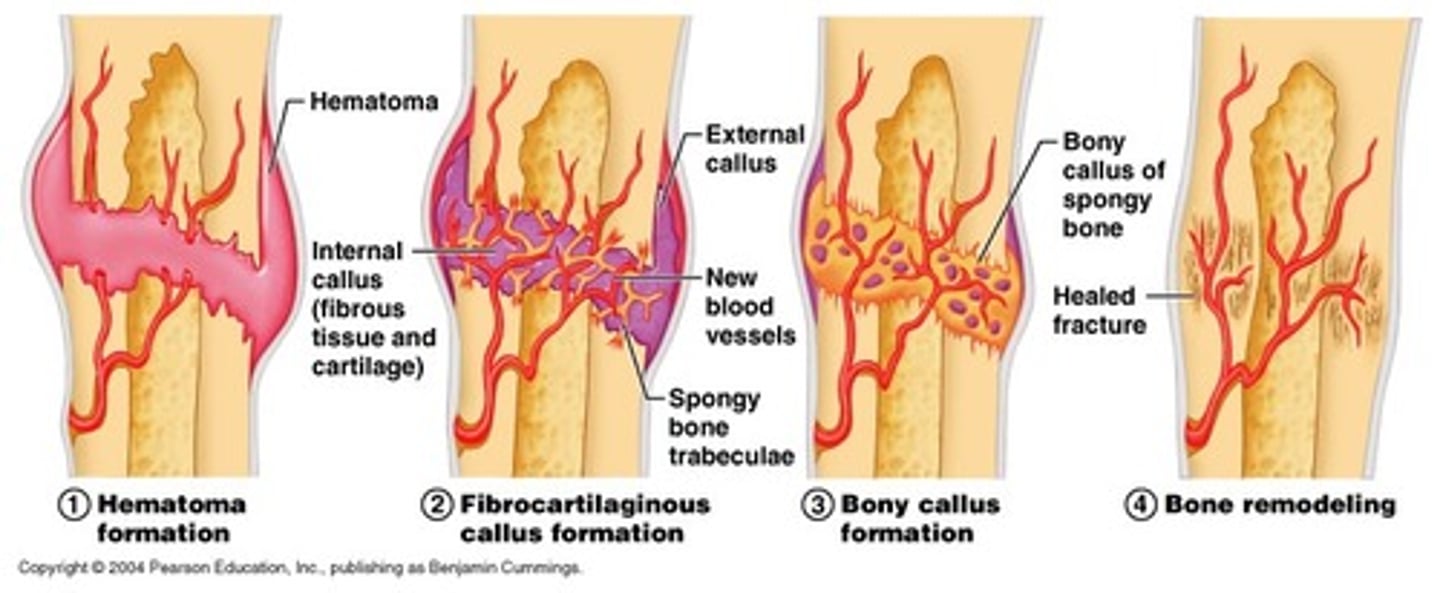 <p>collar of hyaline cartilage and bone that forms around the outside of a fracture and will be eventually replaced by bone</p>