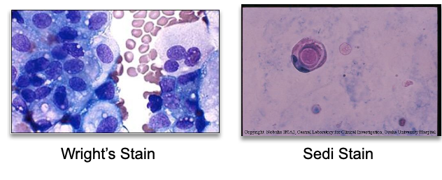 <ul><li><p class=""><strong>Vacuoles</strong> or <strong>irregular nuclei</strong> may suggest:</p><ul><li><p class=""><strong>Viral infection</strong></p></li><li><p class=""><strong>Malignancy</strong> (e.g., <strong>bladder cancer</strong>)</p></li></ul></li><li><p class=""><strong>Refer to cytology</strong> for evaluation</p></li><li><p class="">Stains: <strong>Wright’s</strong> or <strong>Sedi stain</strong></p></li></ul><p></p>