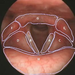 <p>true vocal folds</p>