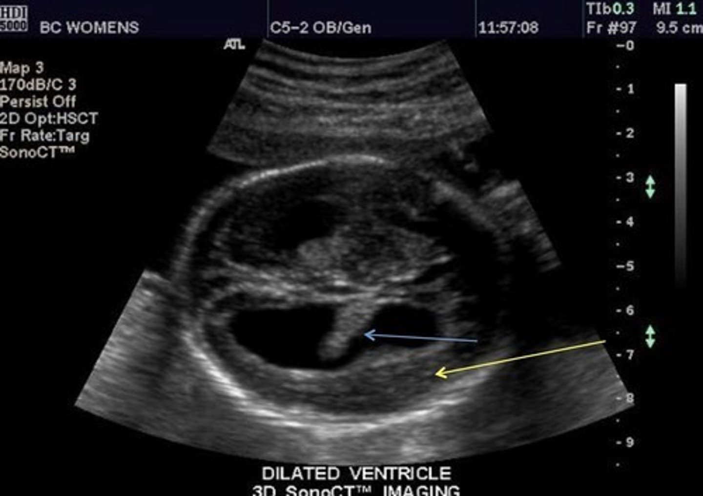 <p>Dilated ventricles</p><p>Dangling choroid plexus</p><p>Enlarged head</p>