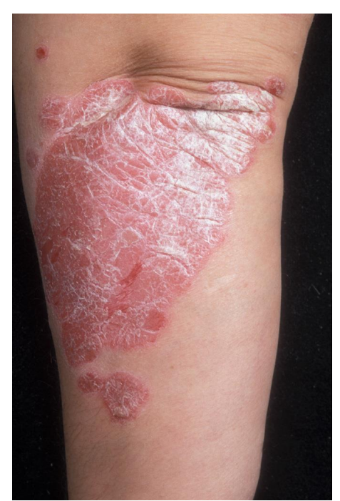 <p>plaque </p><p><em>This patient has chronic plaque psoriasis</em></p>