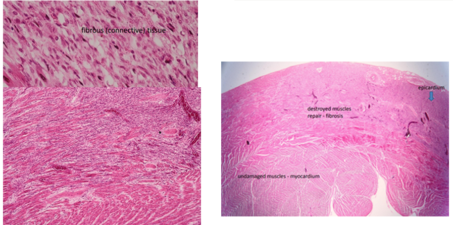 <p><strong>Fibrosis myocardii</strong></p><p><em>Note: myocardium of heart is locally replaced by mature fibrosis tissue with bright staining. </em><span style="color: purple;"><em>Pink area is normal myocardial tissue</em></span><em> while the pale is fibrous tissue. Arises secondary to cardiac stress/damage, cardiovasc. disease. The stress → substances activate fibroblasts + transdifferentiate into myofibroblasts → incr. production of proteins that are dep. in EC matrix → incr. prod. of collagenous scar tissue → myocardial fibrosis.</em></p>