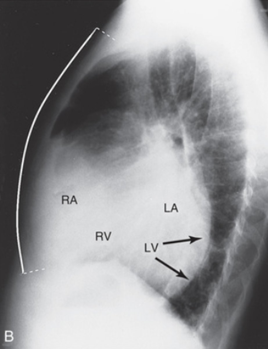 <p>- The right side of the heart is filling retrosternal space</p><p>- Image of heart is imposing on the image of spine</p>
