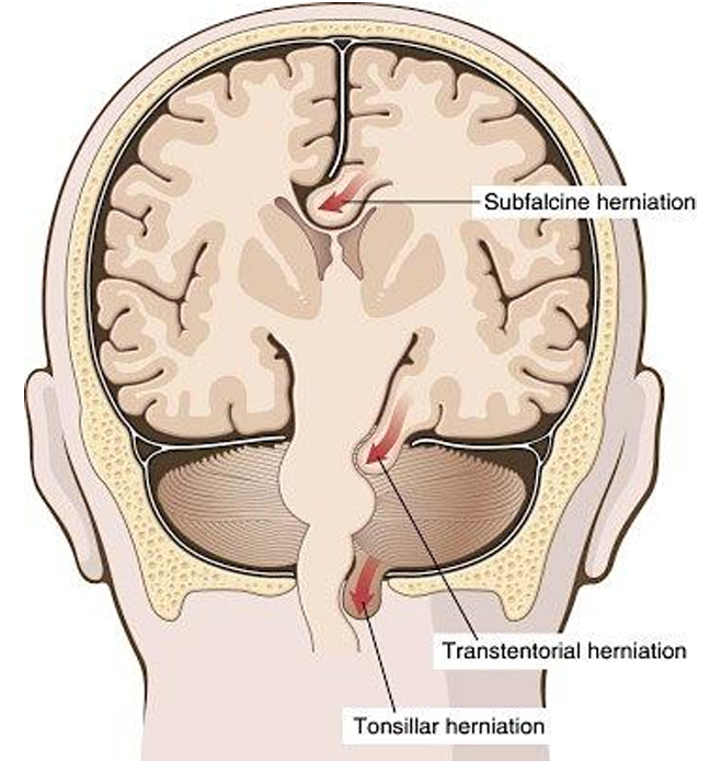 <p><strong><u>Subfalcine herniation</u>:</strong> displacement of cingulate gyrus under falx cerebri</p><p><strong><u>Transtentorial herniation:</u></strong> herniation of uncus of medial temporal lobe through tentorial notch, causing pressure on rostral midbrain</p><p><u>Signs:</u></p><ul><li><p>Ipsilateral dilated and unresponsive pupil</p></li><li><p>Contralateral hemiparesis</p><ul><li><p>Kernohan’s phenomenon: ipsilateral hemiparesis</p></li></ul></li><li><p>Decreases consciousness or coma</p></li><li><p>Signs of raised ICP</p></li></ul><p></p><p><strong><u>Tonsilar herniation:</u></strong> herniation of inferior medial aspects of cerebellum through foramen magnum</p><ul><li><p>Can cause compression of medulla causing cardiac/ respiratory depression and death</p></li></ul><p></p>