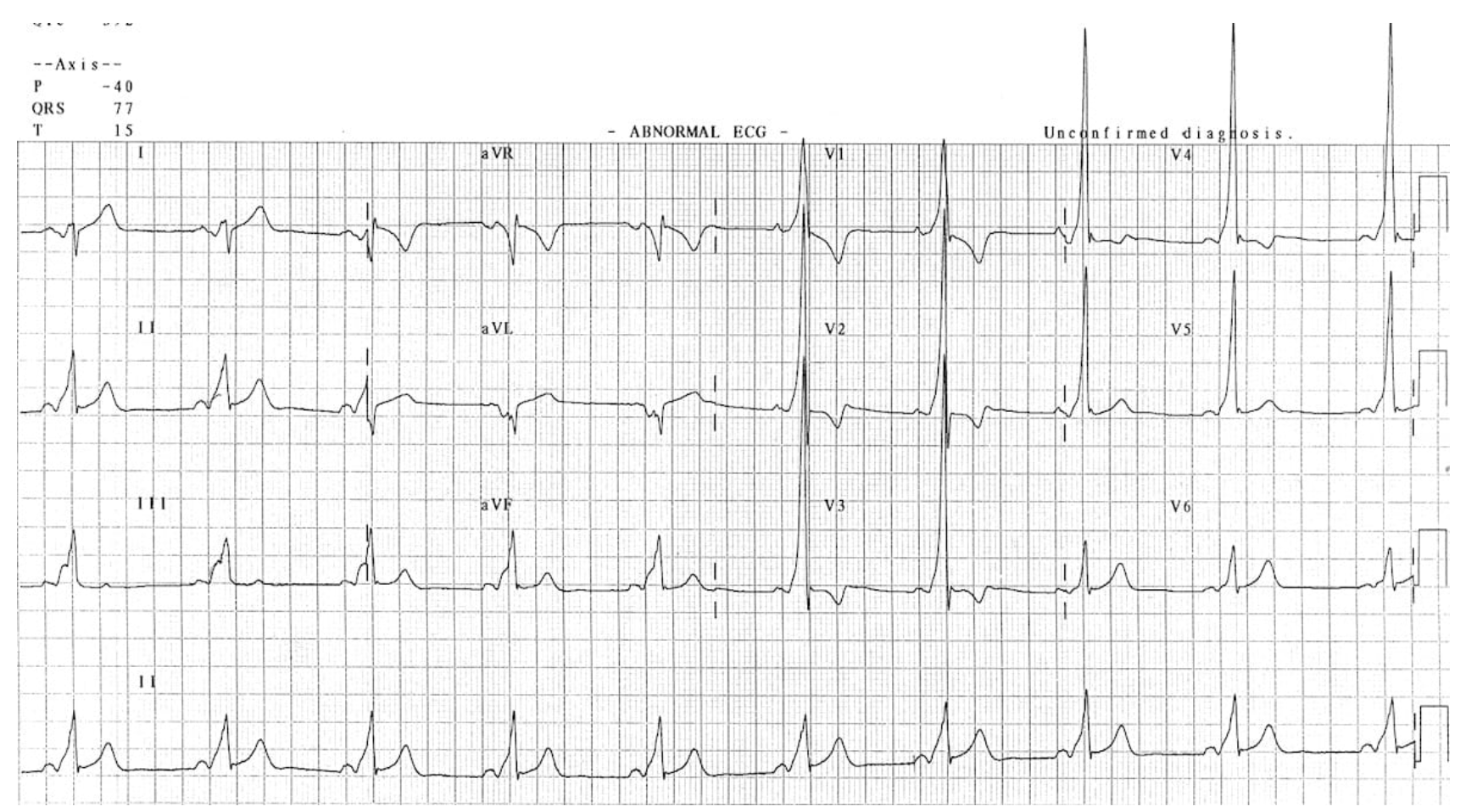 <p>Which patients with WPW are eligible for surgical treatment?</p>