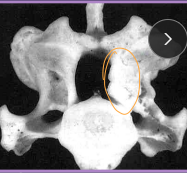 <ul><li><p><span style="color: rgb(136, 136, 136);"><strong>Et: </strong></span><strong>cervical vertebral instability/malformation</strong>, cord/nerve root compression, <strong>disk protrusion → </strong><span style="color: red;"><strong>C5/6-C6/7</strong></span></p></li><li><p><span style="color: rgb(136, 136, 136);"><strong>Sig:</strong></span></p><ul><li><p><strong>Disc-associated:</strong><span style="color: red;"><strong> </strong>middle-aged </span>Lg breeds <span style="color: red;">Dobermans;</span> <span style="color: red;"><strong><u>C6-C7</u></strong> </span><strong><u>IVD protrusion(ventral); 50:50 single/multi</u></strong></p><ul><li><p>Ligamentum flavum hypertrophy (dorsal)</p></li></ul></li></ul></li></ul><ul><li><p><strong>Osseous-associated: </strong><span style="color: red;">young giant breeds, Danes;<strong><u> C6-7</u></strong></span> <strong><u>Vertebral stenosis; multi sites 80%</u></strong></p></li></ul><ul><li><p><span style="color: rgb(136, 136, 136);"><strong>Cs:</strong></span> <strong><u>chronic</u></strong> progressive ataxia, <span style="color: red;">neck pain, proprioceptive deficits, </span><span style="color: red;"><u>Proliferation of the vertebral </u></span><span style="background-color: transparent; font-size: 1.6rem; color: red;"><u>arch</u></span></p></li><li><p><span style="color: rgb(136, 136, 136);"><strong>Dt: </strong></span>Rads(r/o), <strong>CT(bone)</strong>,<strong> MRI(both)</strong> site/severity/parenchymal assessment (#1)</p></li><li><p><span style="color: rgb(136, 136, 136);"><strong>Tx:</strong></span><strong> Mild cases: </strong>restriction, harness, NSAID, gabapentin, good footing</p><ul><li><p><strong>Surgical(static):</strong> direct decompression (ventral slot, dorsal laminectomy), <u>distraction/stabilization w/ spacers/implant</u>s<strong>(dynamic)</strong></p><ul><li><p>domino effect deterioration → adjacent VB effected</p></li><li><p><strong><u>Both Sx and Rx equally successful</u></strong></p></li></ul></li></ul></li></ul><img src="https://knowt-user-attachments.s3.amazonaws.com/dbba7f5a-fef7-470d-9e79-8f6c2e41f4e3.png" data-width="50%" data-align="center"><p></p>