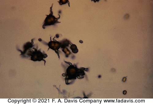 <p>Name this crystal? What is it associated with? what is its pH? normal or abnormal? </p>