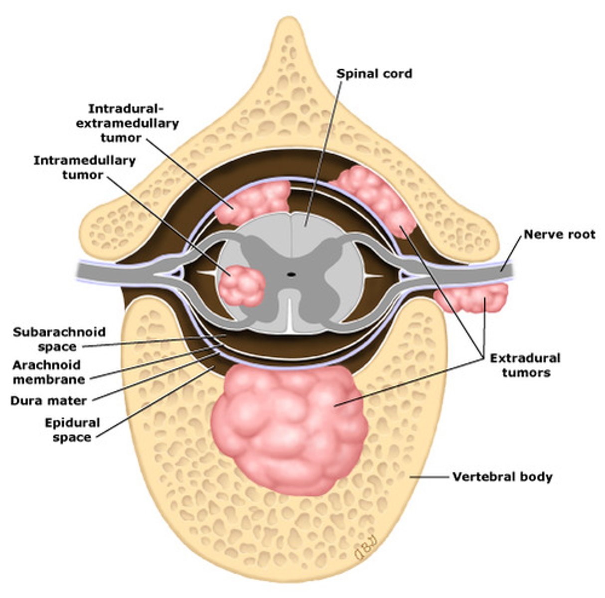 <p>Extradural (often metastatic); thoracic region</p>