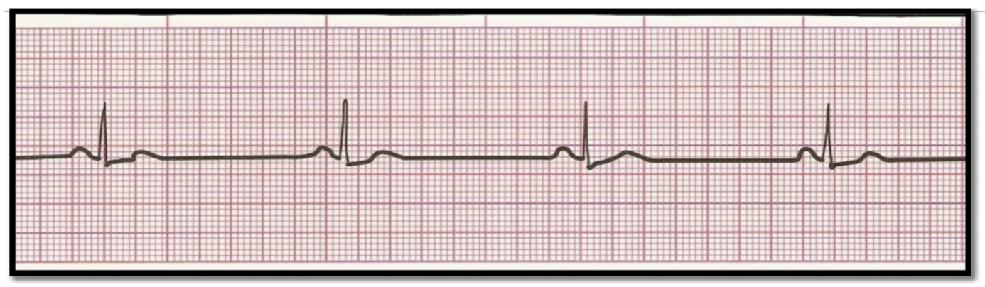 <p>What is the rhythm?</p>