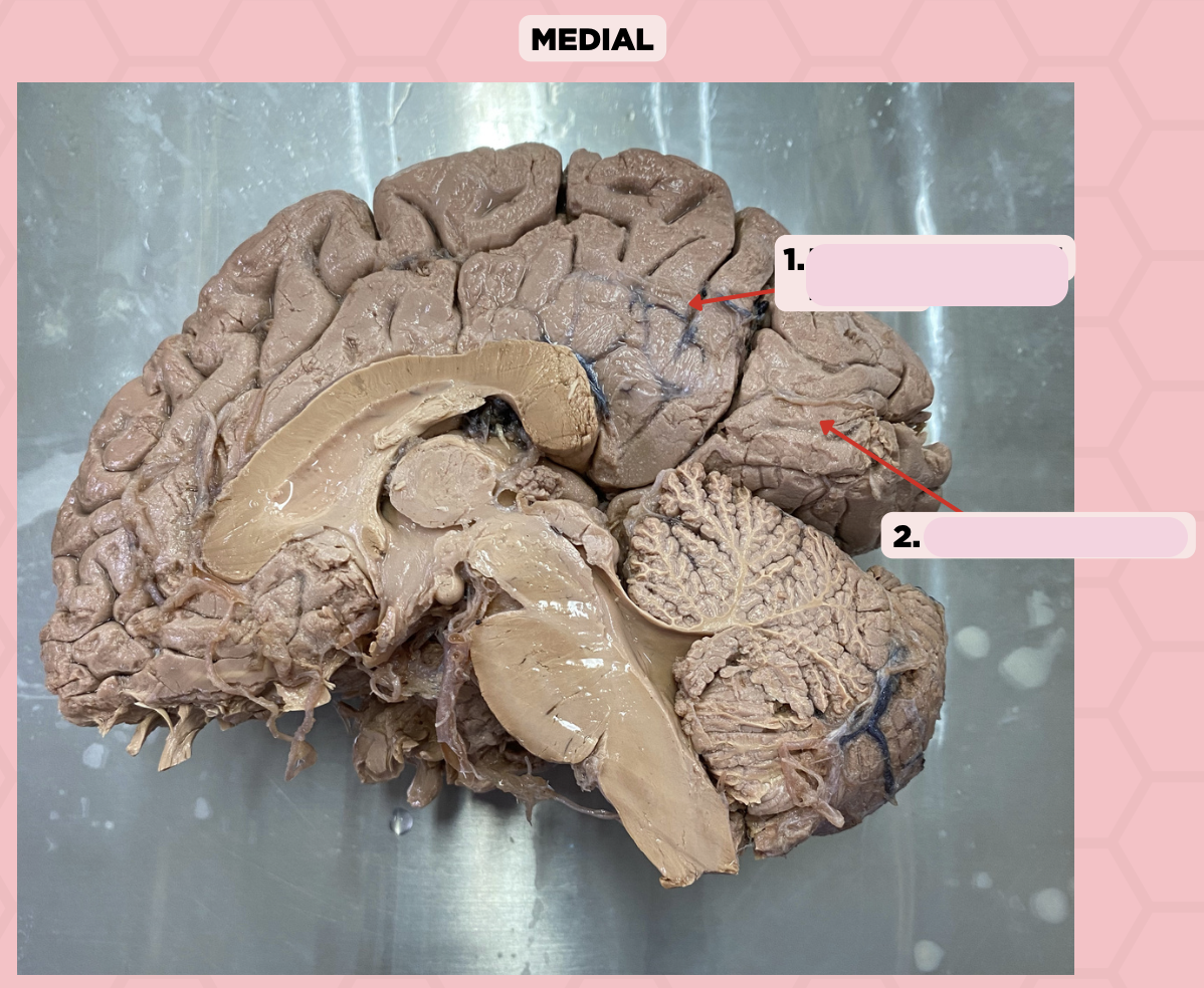 <p>Damage to the gyri surrounding this fissure (Pin #2) could potentially lead to visual impairment and/or blindness</p><p>a. Central Fissure</p><p>b. Parieto-Occipital Fissure</p><p>c. Calcarine Fissure</p><p>d. Lateral Fissure</p>