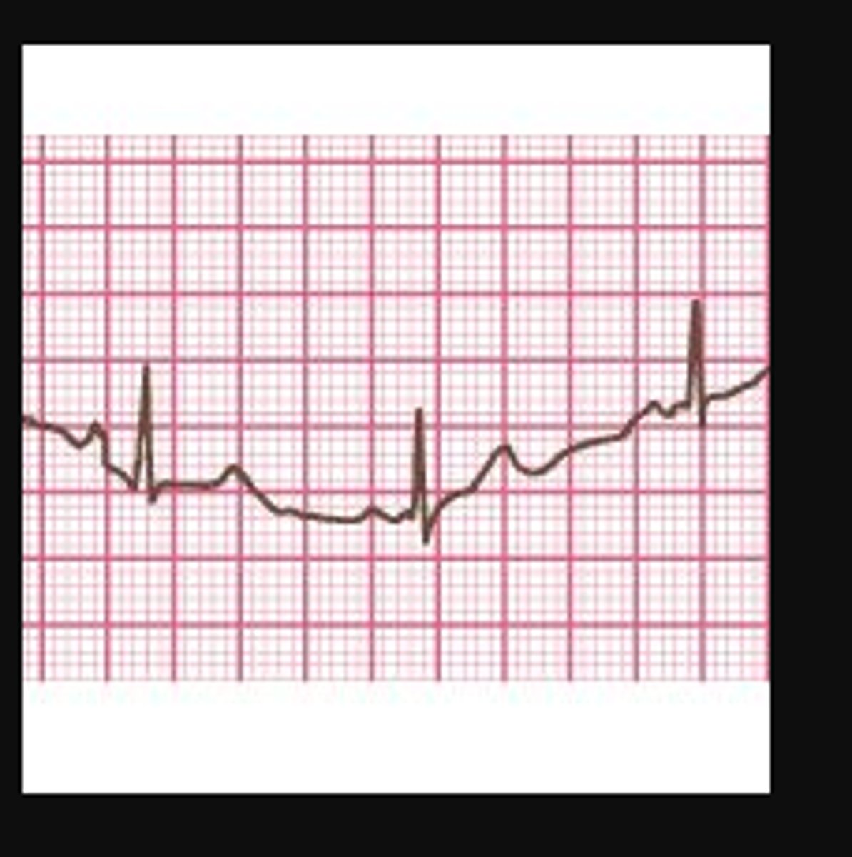 <p>A. Wandering baseline</p><p>A wandering baseline occurs when the stylus moves from the center of an EKG. This can be the result of too much lotion or sweat on the skin or an inadequate attachment to the skin, among other reasons.</p>