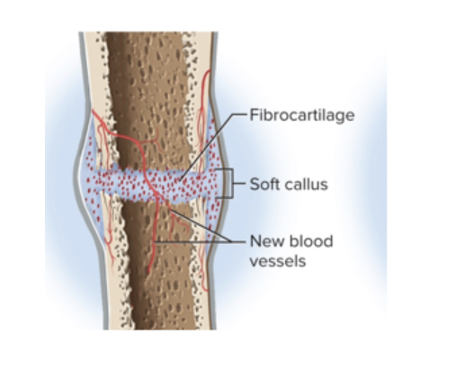 <p>the deposition (deposit) of collagen and fibrocartilage converts granulation tissue to a soft callus</p><p></p>