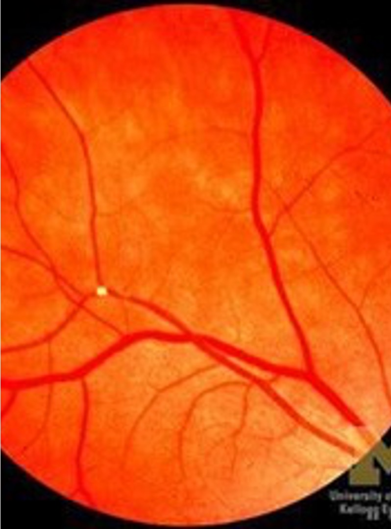 <p>abrupt monocular loss of vision lasting only a few minutes</p>