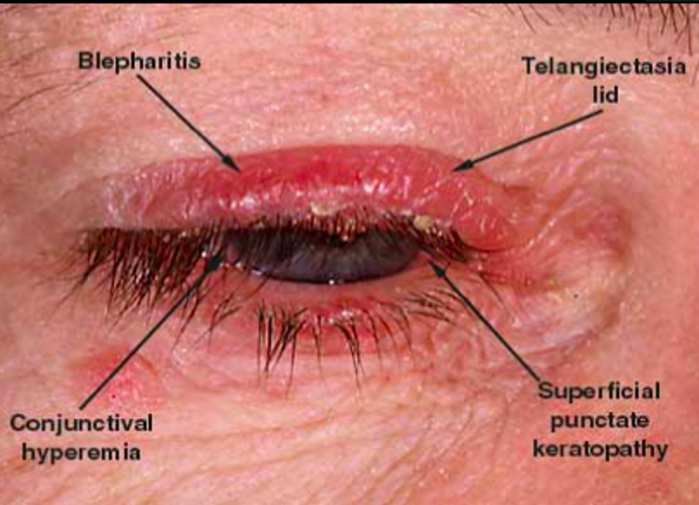 <p>eye irritation</p>