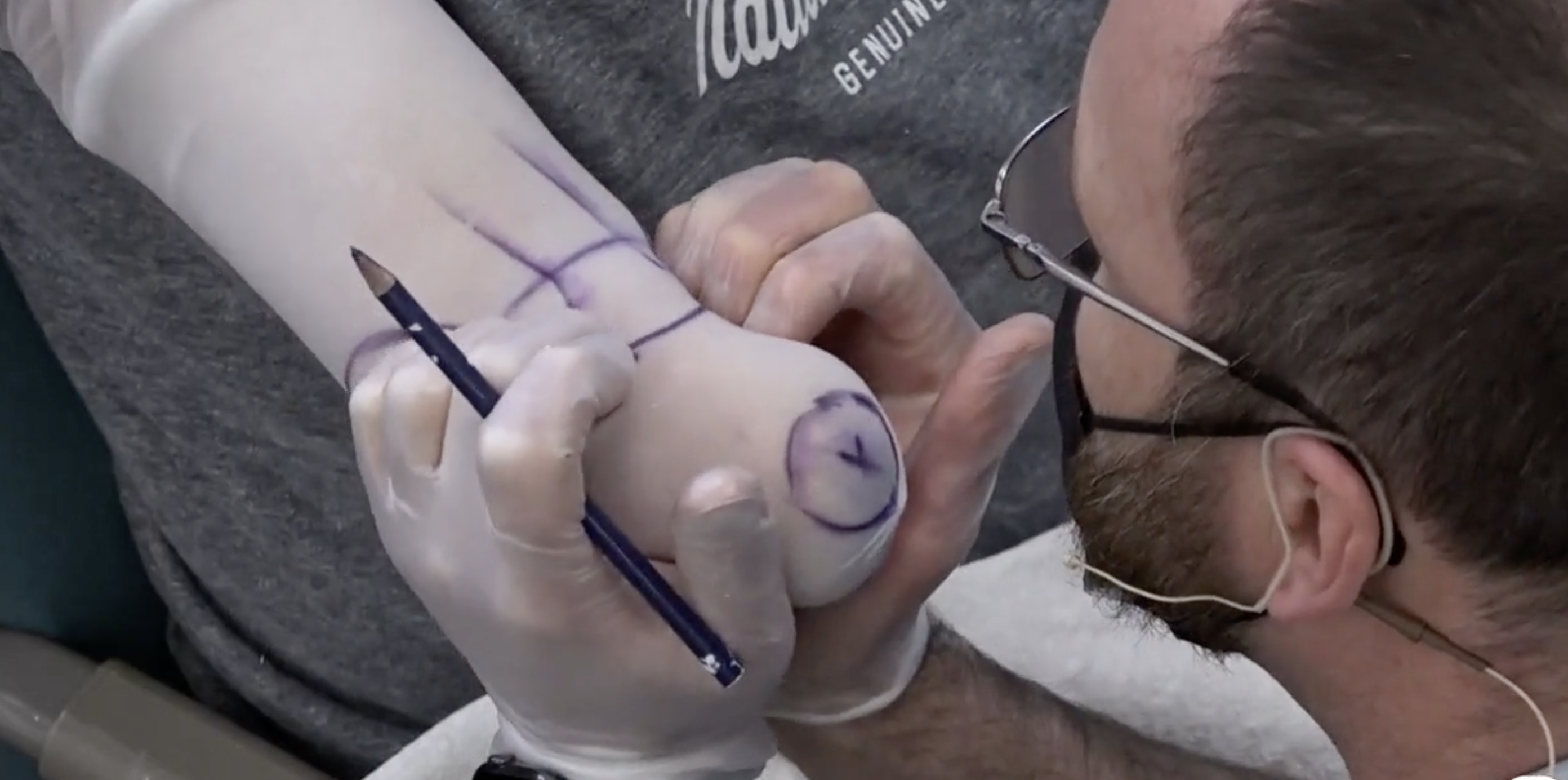 <p>medial towards radius </p><p>if not, the radius will want to slip out of the socket </p>