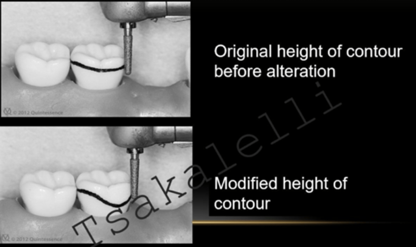 <p>HOC adjustments permits circumferential clasp location above the HOC. What burs do we use for this?</p>