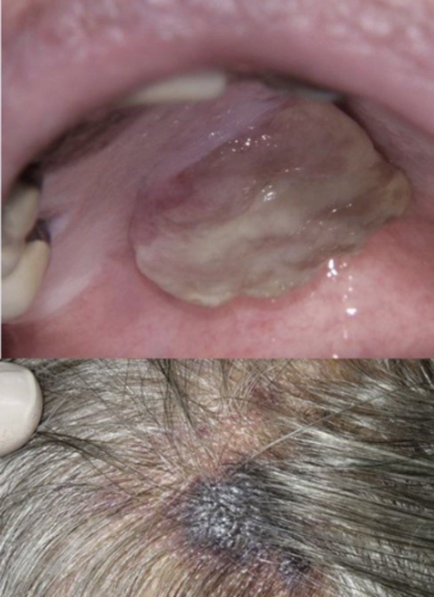 <p>Sarcoma of vascular endothelium</p><p>Seen in elderly patients</p>