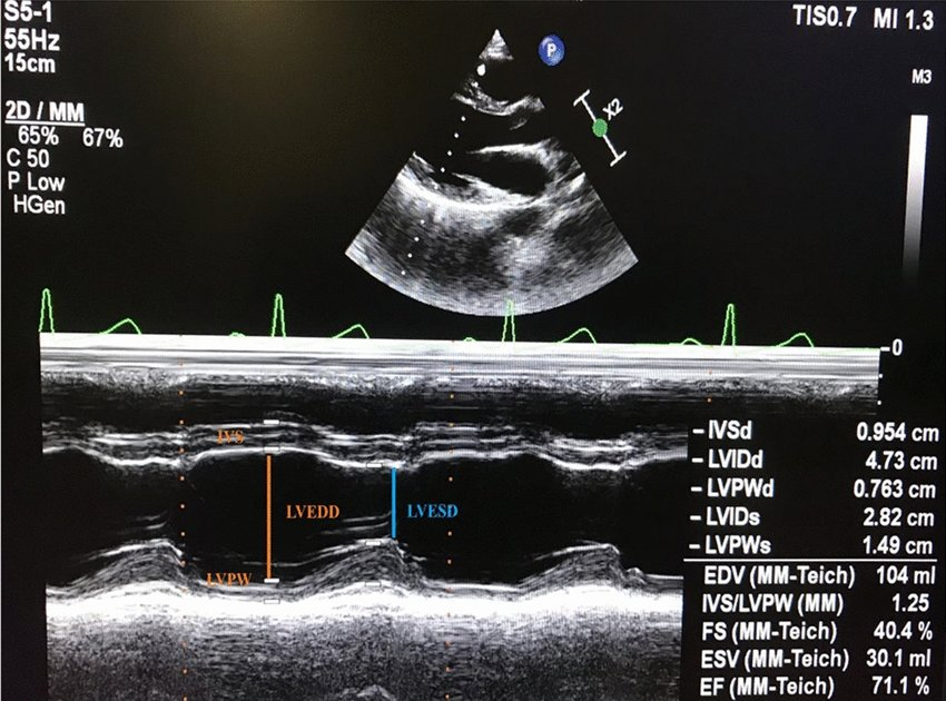 <p>AoV</p><ul><li><p>curser where the AoV leaflets close in diastole</p></li><li><p>aortic root diameter measured at end diastole from the tissue interface of the anterior wall of aortic root to posterior wall of aortic root</p></li><li><p>LA measured at end systole from the trailing tissue interface to posterior tissue interface</p></li></ul><p>MV</p><ul><li><p>cursor at the mitral valve leaflet tips</p></li><li><p>E point septal separation - space between the anterior leaflet and anterior LA wall</p></li></ul><p>LV basal wall</p><ul><li><p>cursor just past the mitral valve leaflets</p></li><li><p>IVS measured at end diastole from the right to left surfaces of the IVS</p></li><li><p>LVIDd measured at end diastole from the tissue edge of anteroseptal interface to tissue edge of inferolateral interface</p></li><li><p>Inferolateral wall diameter measured in end diastole from the endocardial surface to epicardial surface of the posterior wall</p></li><li><p>LVIDs measured at end systole from the tissue edge of anteroseptal interface to tissue edge of inferolateral interface</p></li></ul><p></p>