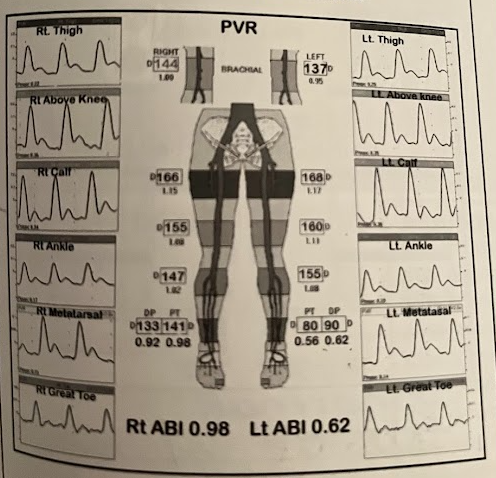 <p>Please review this PVR and segmental pressure study and select an appropriate comment below</p>
