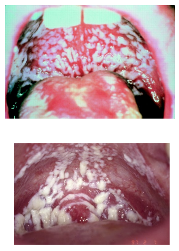 <p>Mucosal candidiasis: <strong>white plaques</strong> on <strong>mouth</strong> and <strong>throat</strong> ; called <strong>thrush</strong><br>Proliferates in <strong>warm moist</strong> areas<br>HIV patients: <strong>oral candidiasis</strong>, may spread to <strong>oesophagus</strong> ; indicates <strong>AIDS</strong><br>Diagnosis: scrapings of <strong>budding yeast</strong> ; & organism <strong>cultured</strong><br>Vaginal candidiasis symptoms: <strong>itching</strong> and <strong>burning pain</strong>, with <strong>discharge</strong></p>