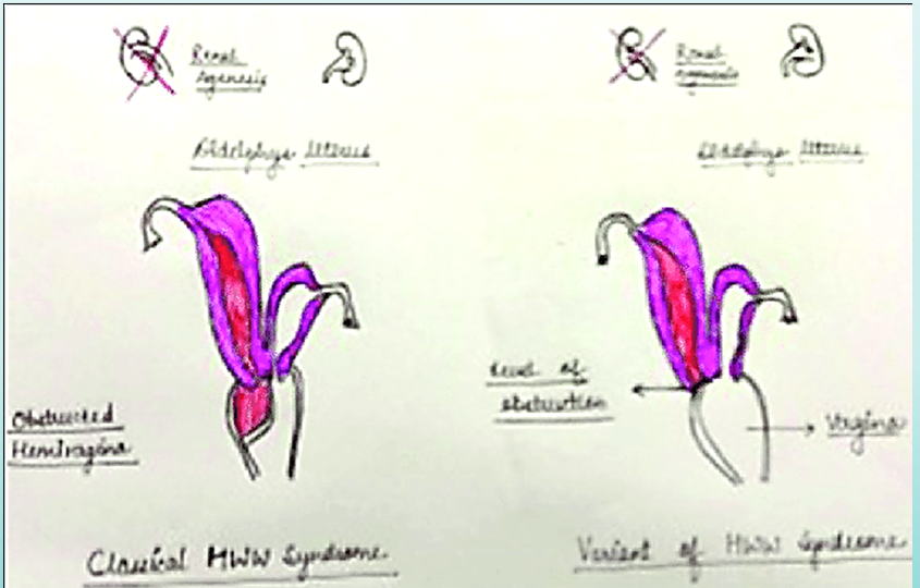 <ul><li><p>uterus didelphys with obstructed unilateral vagina</p></li><li><p>agenesis of kidney and ureter on same side as obstruction</p></li></ul>
