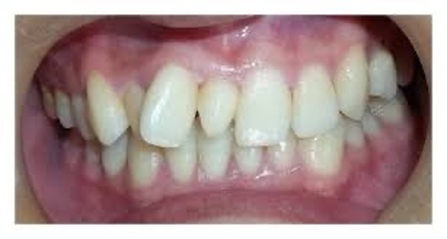 <p>What dental anomaly is this (extra tooth in maxillary anterior region)?</p>