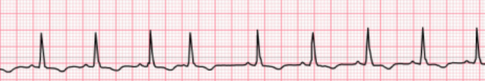 <p>Determine the atrial dysrhythmia</p><p></p>