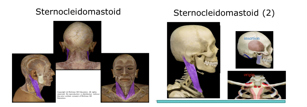 <p>Paired thin, belt-shaped muscles from mastoid process to top of sternum. Flex the head forward, each rotates the head to opposite side. Shake head no</p>