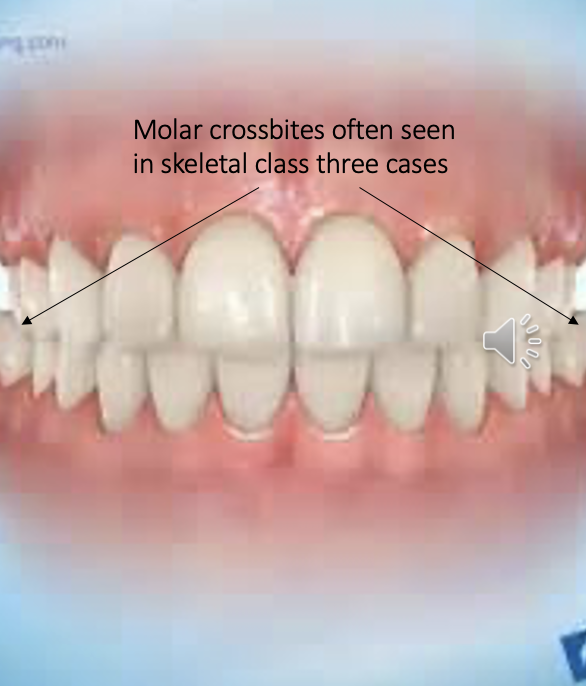 <ul><li><p>when the buccal cusps of the upper molars sit inside of the buccal cusps of the lower molars</p></li></ul><p></p>
