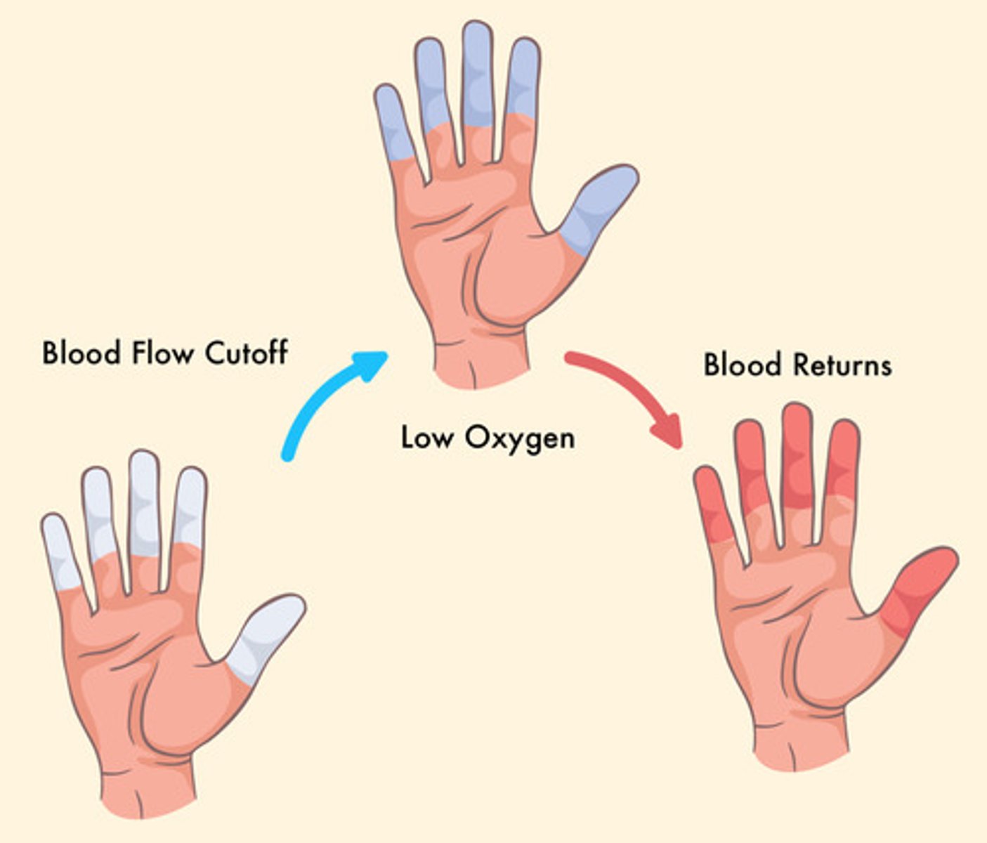 <p>a peripheral arterial occlusive disease in which intermittent attacks are triggered by cold or stress</p>