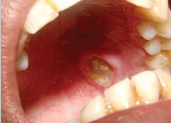 <p>What is necrotizing sialometaplasia?</p>