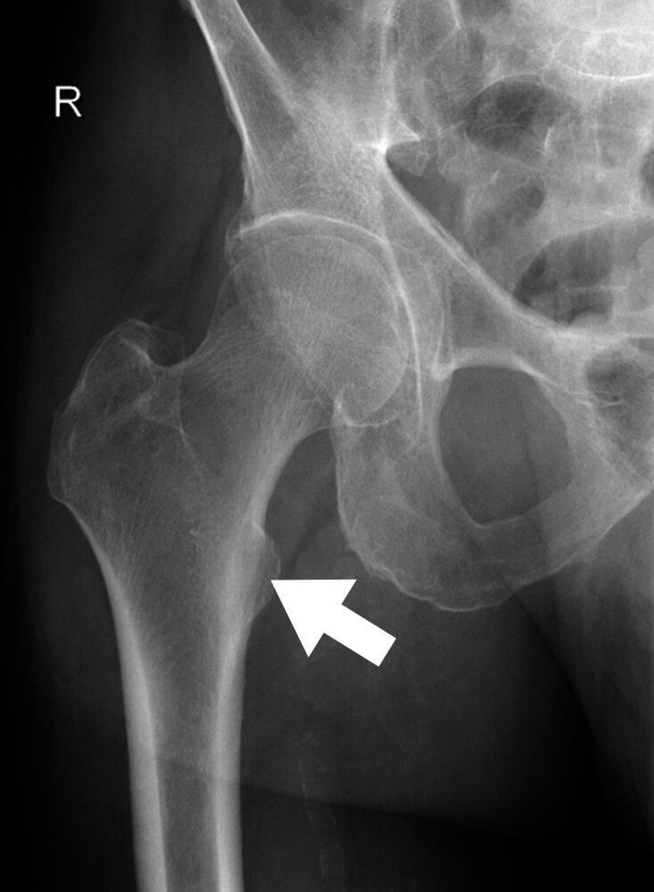 <p>22. The X-ray image (anterior-posterior view) of a right hip joint included in the figure is marked with an arrow pointing to an anatomical structure.</p><p>Which hip joint movement is the muscle attaching to this structure primarily responsible for?</p><p>A. Flexion</p><p>B. Extension</p><p>C. Internal rotation</p><p>D. External rotation</p><p>E. Abduction</p>