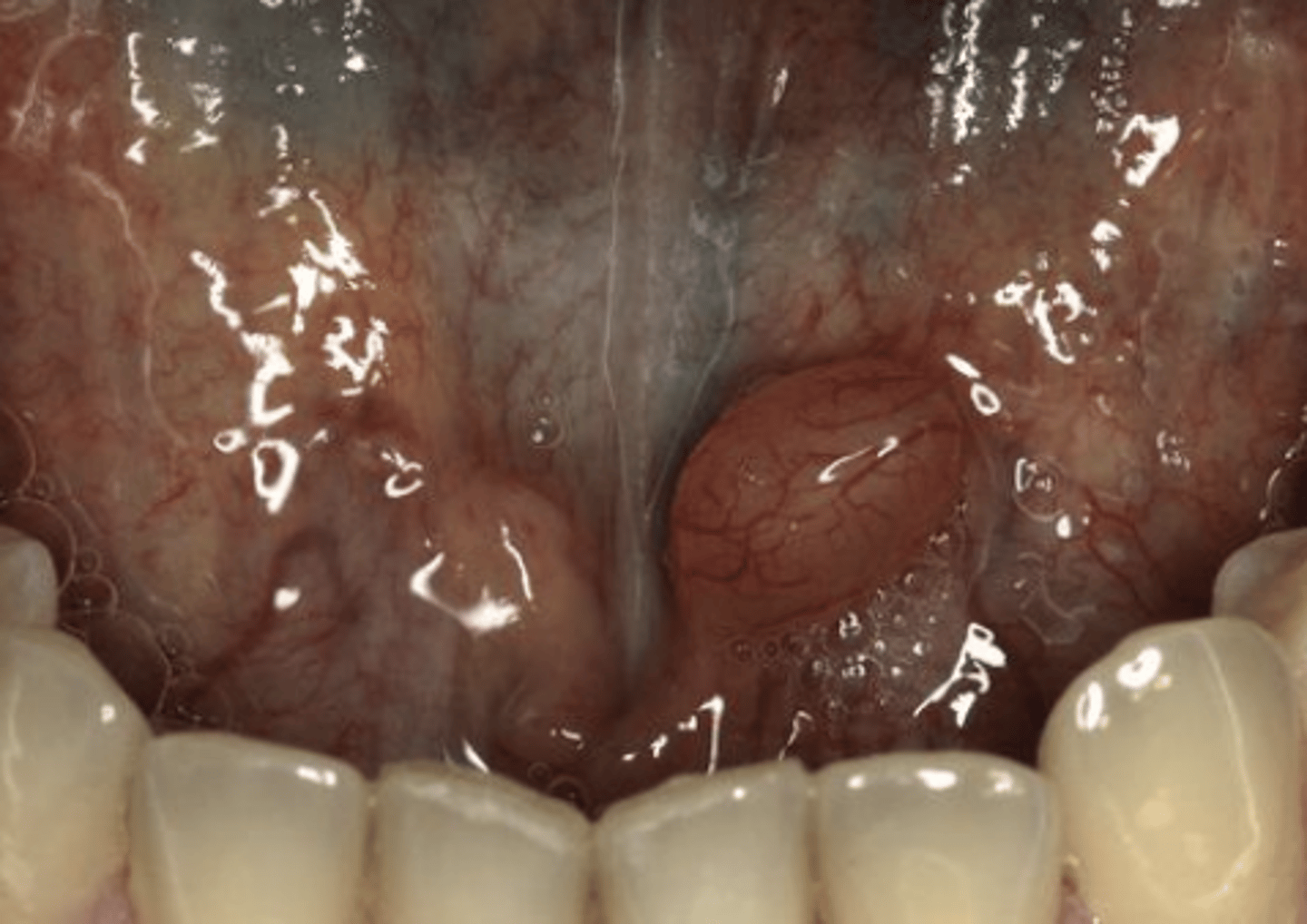 <p>Floor of the mouth</p>