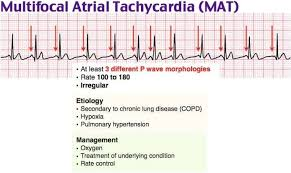 <p>PP:<br>rate: 100-150 bpm</p><p>rhythm: irregular</p><p>pacer site: shifts back&amp;forth from from SA to ectopic (2+) atrial pacer sites</p><p>morphology: 3 abnormal p waves</p><p>interval:<br>PR: varies<br>QRS: normal</p><p>E: <strong>COPD</strong><br>elderly<br>CAD<br>valvular disease<br>HTN<br>cor pulmonale<br><strong>digoxin toxicity</strong><br>hypokalemia<br>hypomagnesemia</p><p>TX:<br>tx underlying condition<br>abx x PRN<br>nebulizers<br>IVF<br>electrolyte replacement</p>