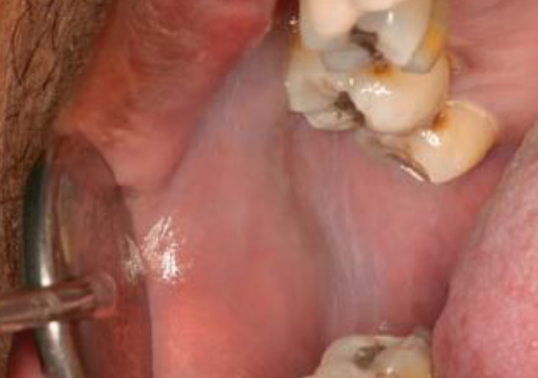 <p>diffuse, gray-white, milky lesions on bilateral mucosa</p>