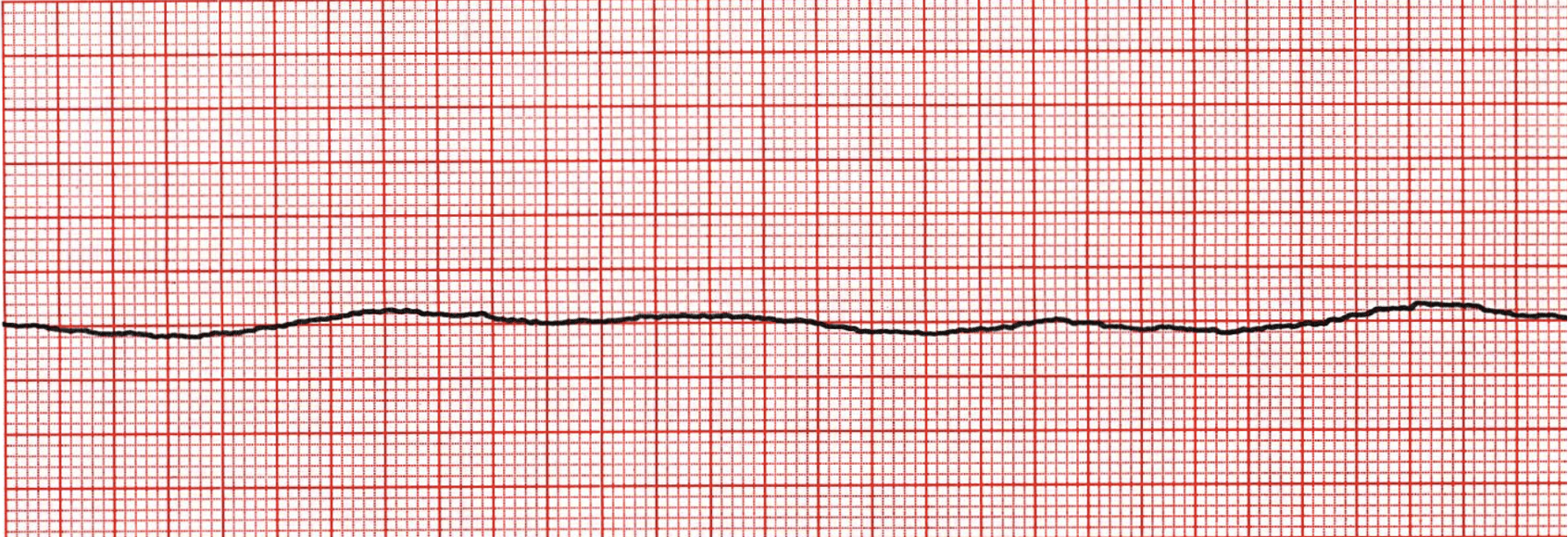 <p>What does this refer to “Flatline- no electrical activity”</p>