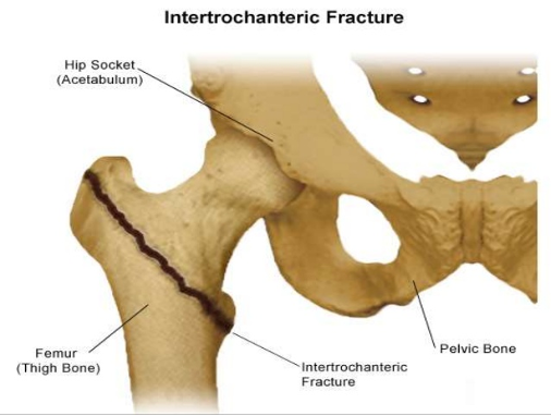 <p><span><u>Anatomy:</u></span></p><ul><li><p><span>Extracapsular</span></p></li><li><p><span>Good cancellous bone</span></p></li><li><p><span>Highly vascular</span></p></li><li><p><span>Abundant blood supply</span></p></li></ul><p><span><strong>Displaced-</strong>shortened and externally rotated</span></p><p></p>