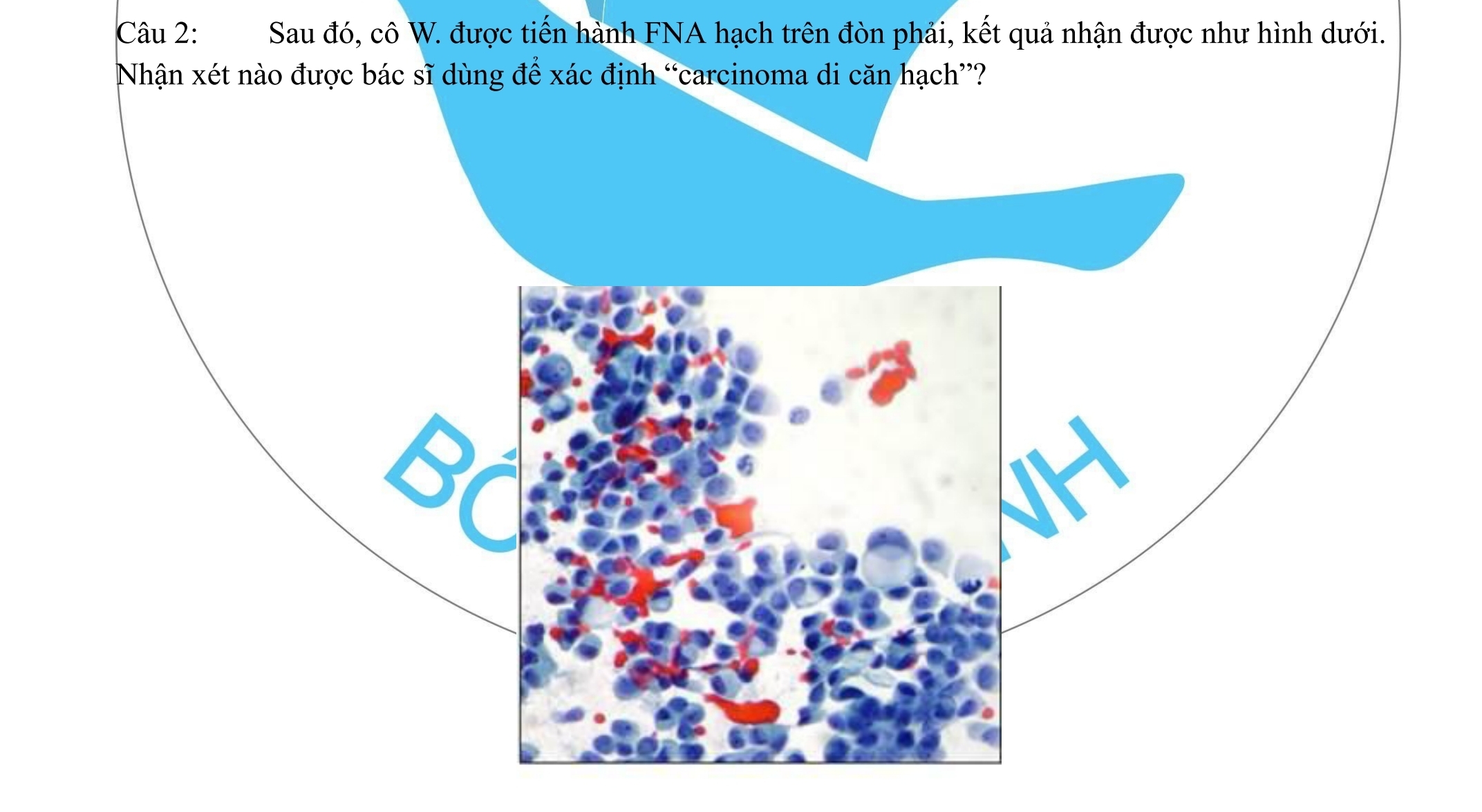 <p>Câu 1. Cô W. có carcinoma vú xâm lấn grad 3 nhưng không chấp nhận chẩn đoán; nên làm gì để xác định tình trạng? <br />
A. Tiêm … <br />
B. Làm xét nghiệm huyết thanh … <br />
C. Cho sinh thiết hạch trên đòn phải, nếu là carcinoma thì chính xác là ung thư vú. <br />
D. Không cần làm thêm xét nghiệm gì khác.</p>