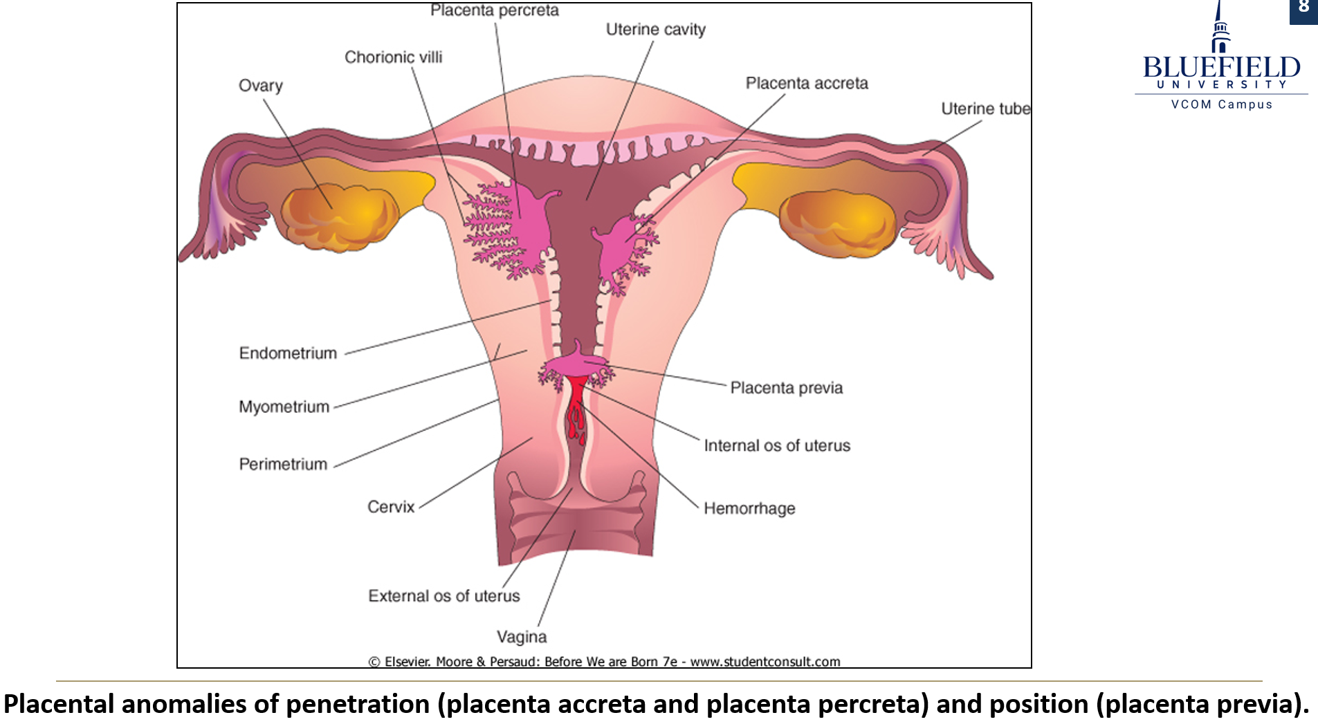 <p>What is <strong>placenta accreta </strong>and how does it differ from <strong>placenta percreta?</strong></p>