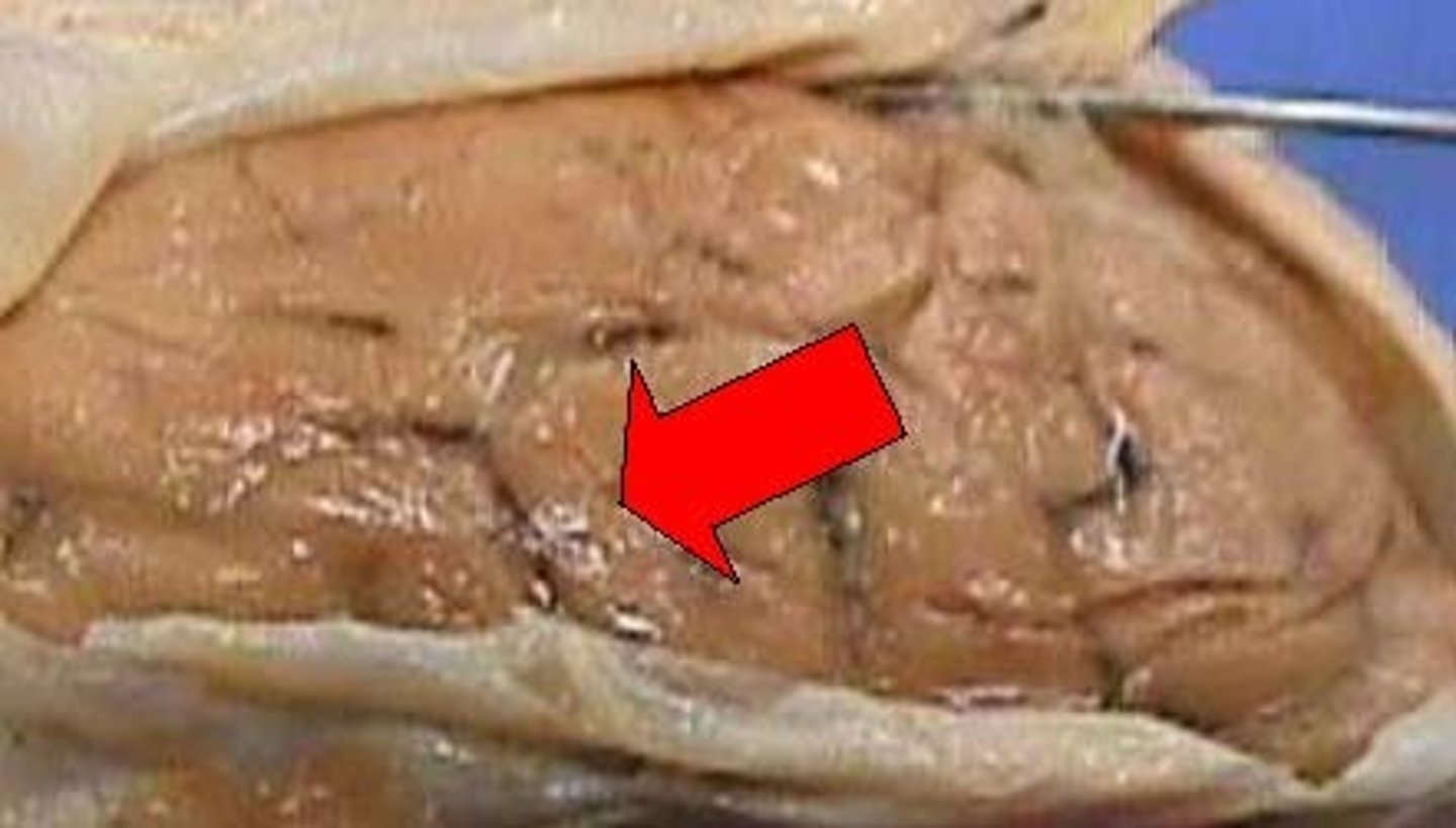 <p>Covering. tan portion of brain on bottom</p>
