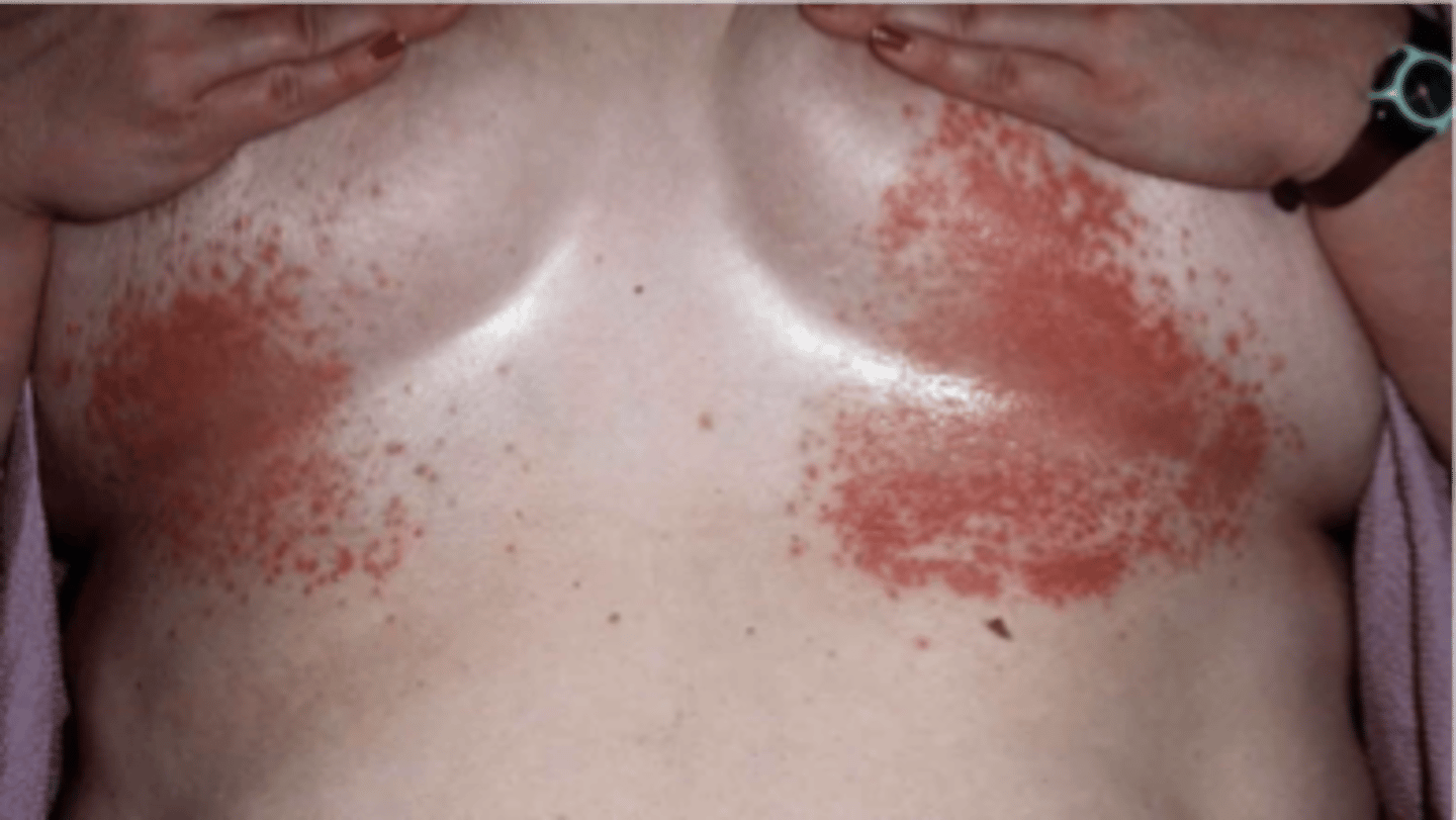 <p>name the skin pathology</p>
