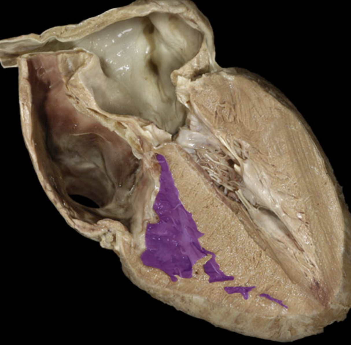 <p>Right ventricle </p>