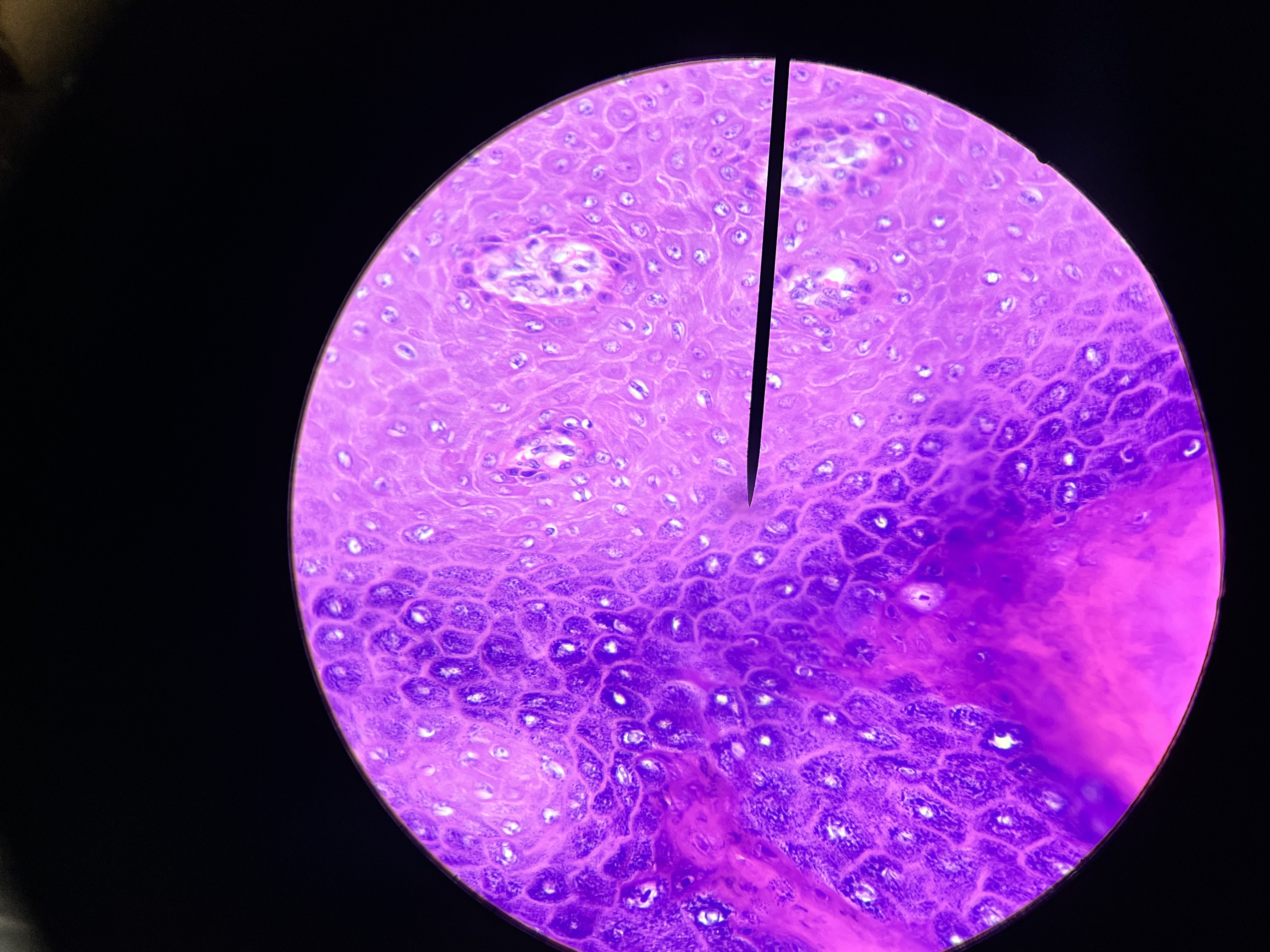<p>A viral skin infection characterized by small, raised, painless bumps on the skin. It is commonly seen in children and can resolve spontaneously. </p>