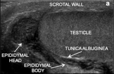 <p>Normal Testicular: hemogenous echotexture</p>