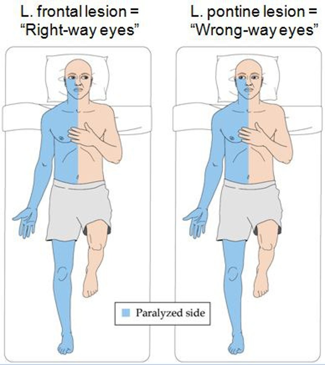 <p>AWAY</p><p>(ex: L cortical lesion or stroke --&gt; R hemiparesis --&gt; L gaze TOWARD side of lesion)</p>