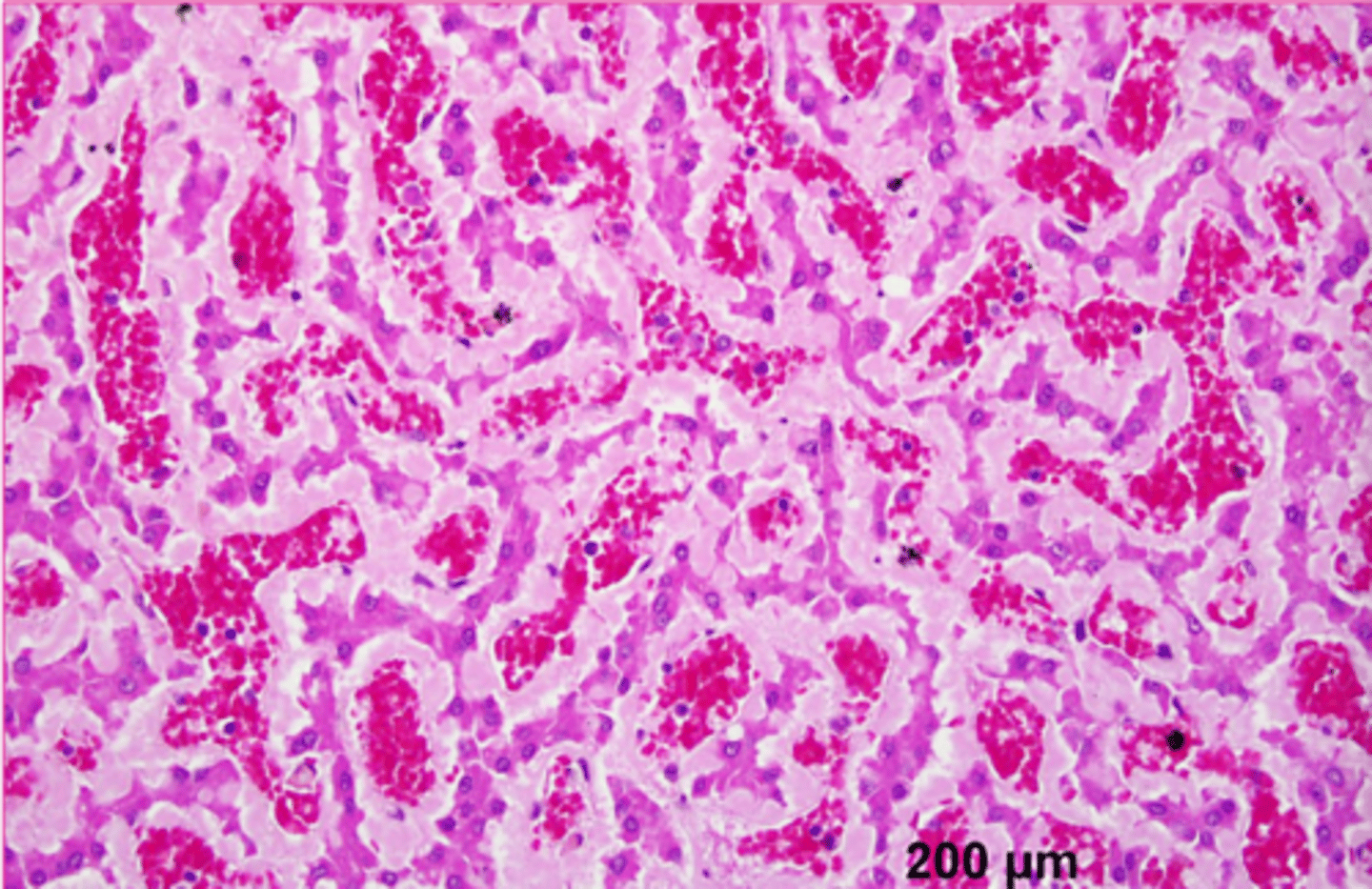 <p>describe the extracellular accumulation</p>
