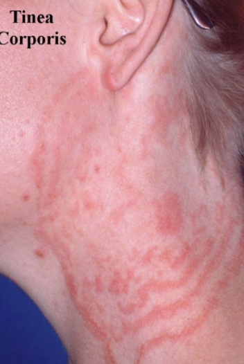 <p>body.</p><p>§ “Traditional” “ ringworm”</p><p>§ Clearing, scaling and raised, red edges; dry</p><p>§ Expands out = Hyphae only seen on edges</p><p>§ Treatment: Topical 2-4 weeks</p><ul><li><p>Terbinafine</p></li><li><p>Miconazole</p></li><li><p>Clotrimazole</p></li></ul><p></p>