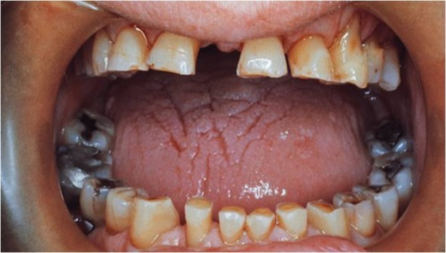 <p>Bruxism, form of this, excessive grinding. Wearing of teeth from tooth to tooth contacts, malocclusion, grinding and mastication.</p>