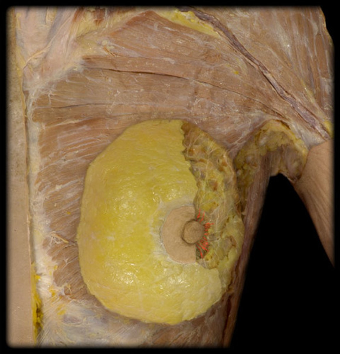 <p>conical to pendulous, with nipple at its apex</p>